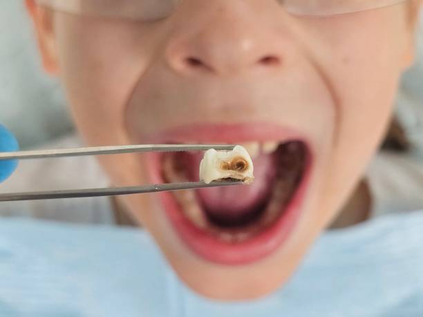 Best Emergency Wisdom Teeth Removal in Matamoras, OH